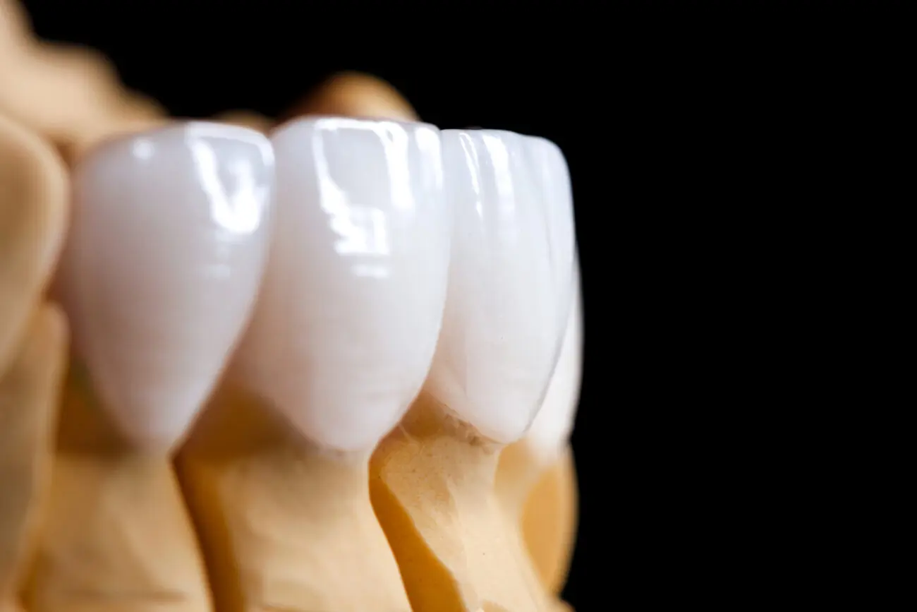 Choosing Dental Crowns vs. Porcelain Veneers
