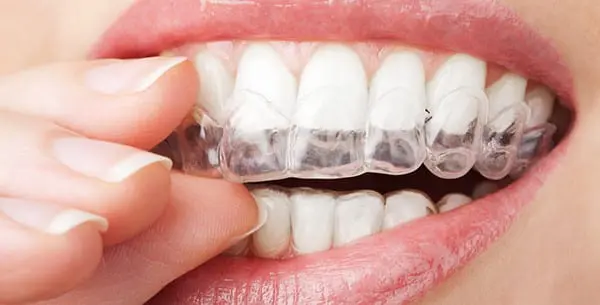 How Long is Invisalign Treatment?