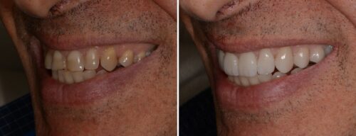 Results after dentistry at AH Smiles