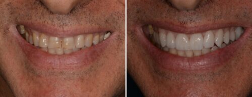 Results after dentistry at AH Smiles