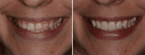 Results after dentistry at AH Smiles