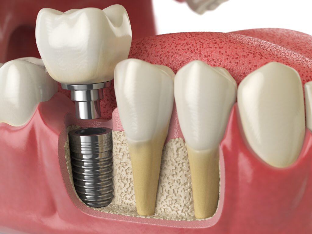 Are Dental Implants For Me?