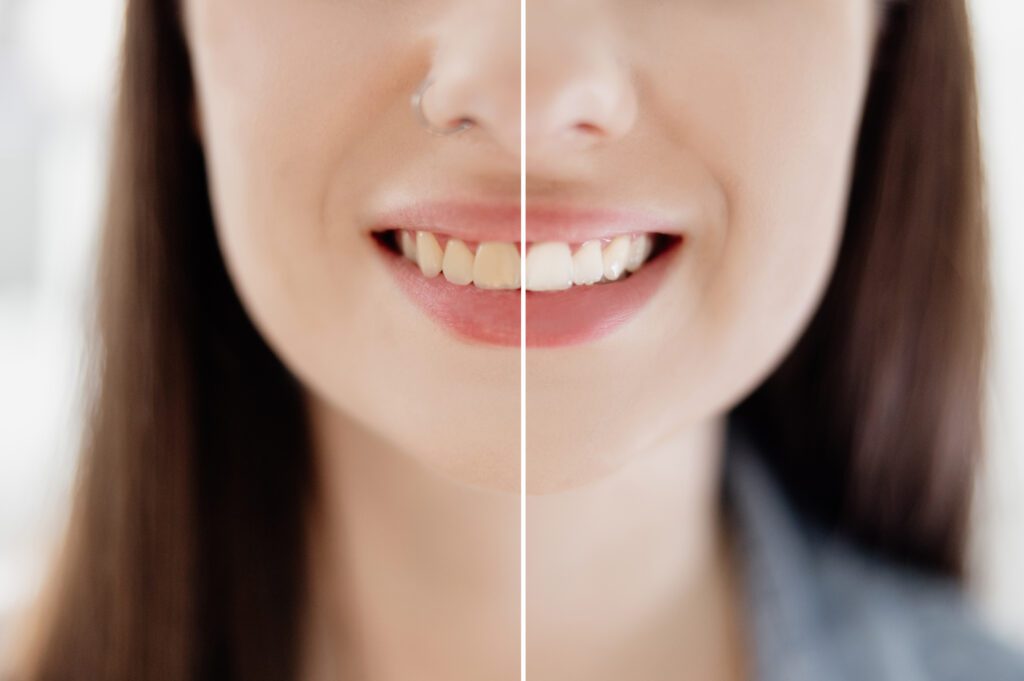 How to Whiten Deep Tooth Stains