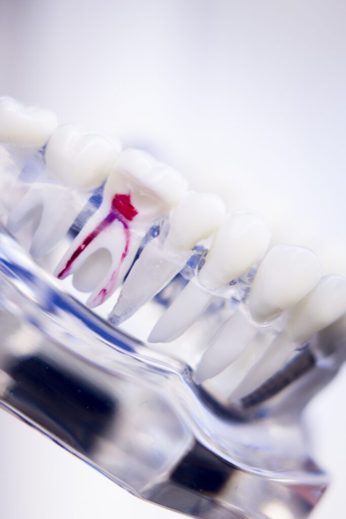 A ROOT CANAL in Arlington Heights, IL helps alleviate pain, not cause it