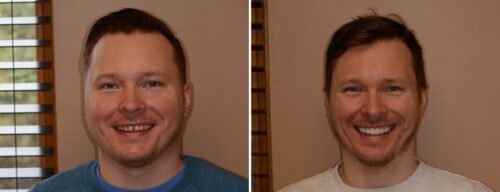 Results after dentistry at AH Smiles