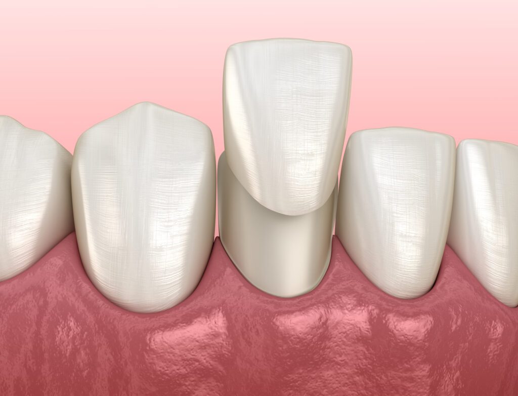 PORCELAIN VENEERS in ARLINGTON HEIGHTS IL can help restore many minor imperfections in your smile