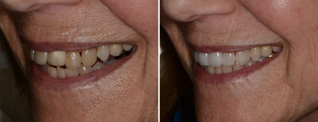 Dental patient before and after CEREC crowns and veneers at AH Smiles