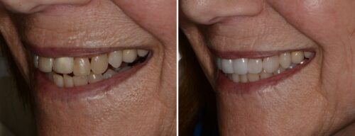 Results after dentistry at AH Smiles