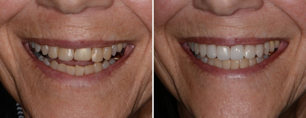 Dental patient before and after veneers and crowns at AH Smiles
