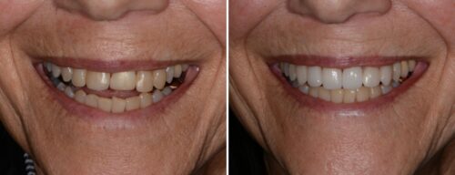 Results after dentistry at AH Smiles