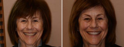 Results after dentistry at AH Smiles