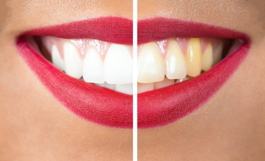 Discolored Teeth in Arlington Heights IL could be caused by a variety of factors.