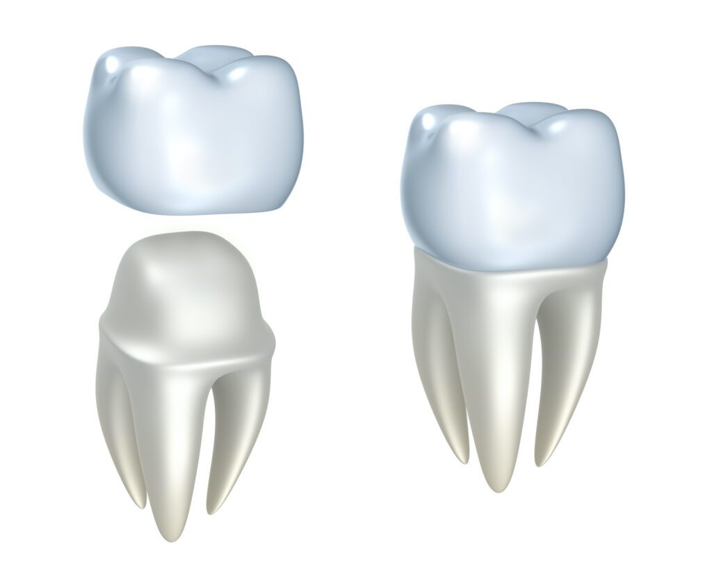 A Dental Crown in Arlington Heights IL can help restore your bite for many dental conditions