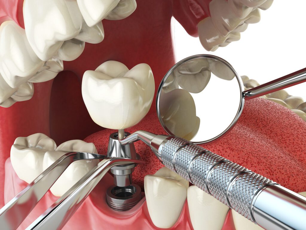 Dental Implants in Arlington Heights, IL can help many patients restore their smile after losing a tooth
