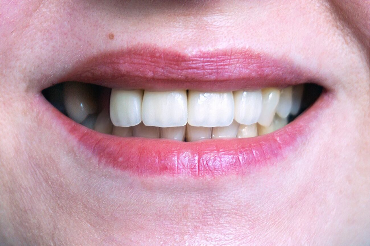 Replace your missing teeth in Arlington Heights, IL