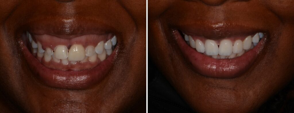 Dental patient before and after getting CEREC crowns at AH Smiles