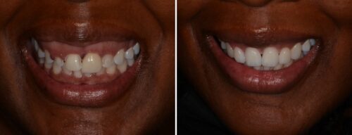 Results after dentistry at AH Smiles