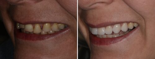 Results after dentistry at AH Smiles