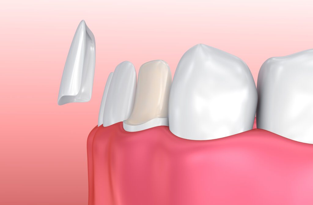 discolored teeth in Arlington Heights IL could be treated with cosmetic procedures