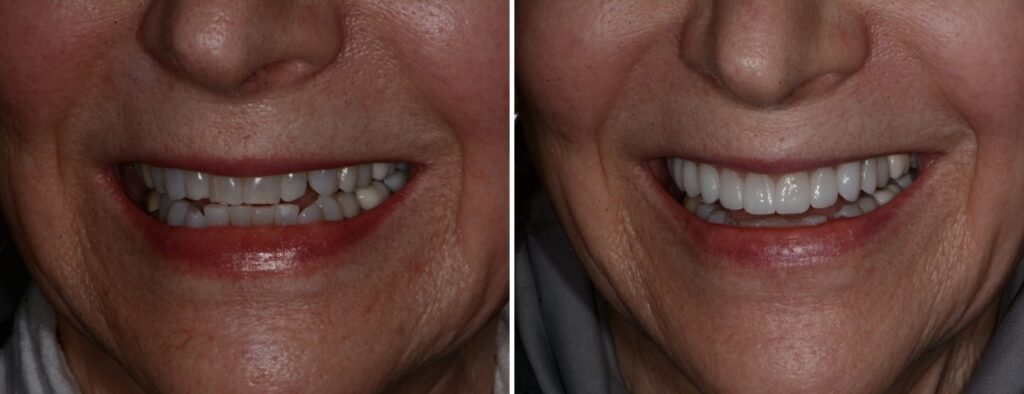 Dental patient before and after veneers at AH Smiles