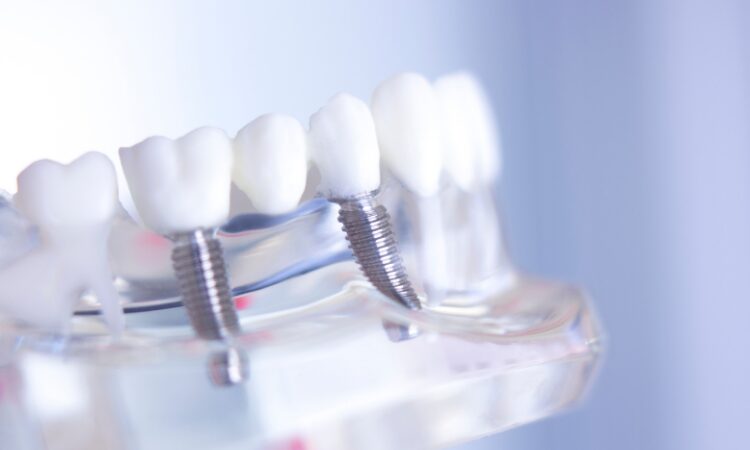 Dental implants have become a preferred solution for replacing missing teeth due to their durability, functionality, and natural appearance.