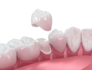 What to Do When a Dental Crown Falls Off in Arlington Heights, IL