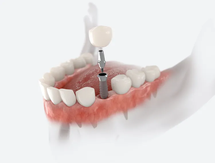 Are Dental Implants Worth the Investment? in Arlington Heights, IL