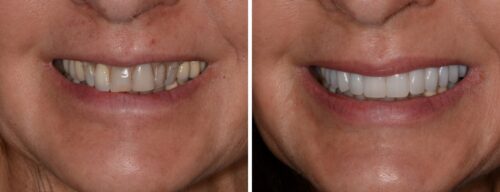 Results after dentistry at AH Smiles