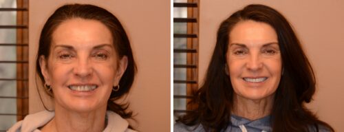 Results after dentistry at AH Smiles