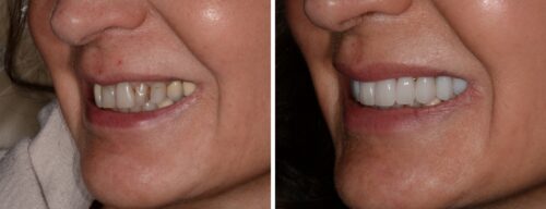 Results after dentistry at AH Smiles
