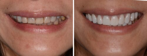 Results after dentistry at AH Smiles