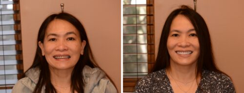 Results after dentistry at AH Smiles