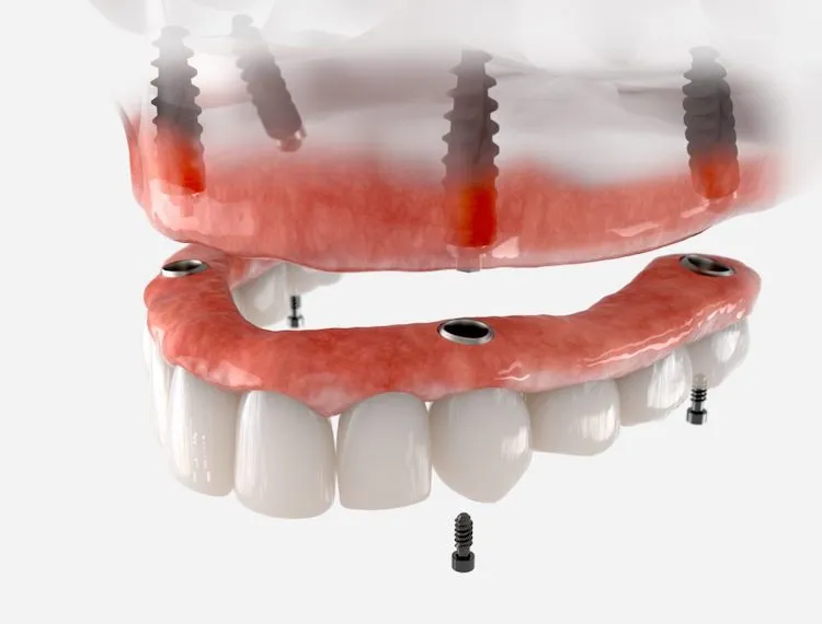 Implant-Supported Dentures: A Stable Solution in Arlington Heights, IL